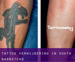 Tattoo verwijdering in South Barnstead