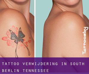 Tattoo verwijdering in South Berlin (Tennessee)