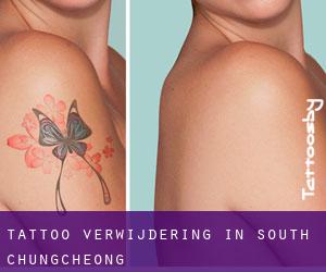 Tattoo verwijdering in South Chungcheong