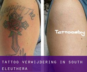 Tattoo verwijdering in South Eleuthera