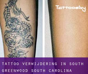 Tattoo verwijdering in South Greenwood (South Carolina)