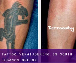 Tattoo verwijdering in South Lebanon (Oregon)