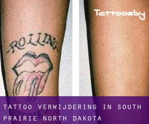 Tattoo verwijdering in South Prairie (North Dakota)