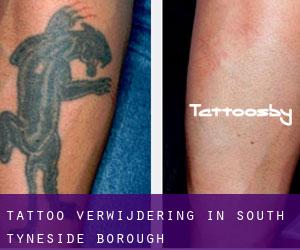 Tattoo verwijdering in South Tyneside (Borough)
