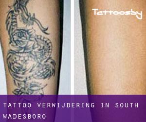 Tattoo verwijdering in South Wadesboro