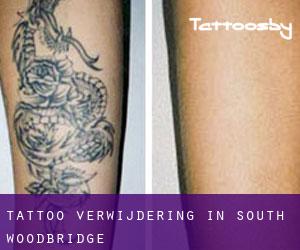 Tattoo verwijdering in South Woodbridge