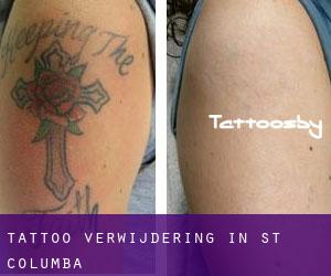 Tattoo verwijdering in St. Columba