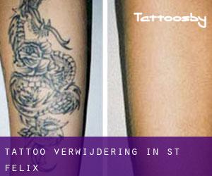 Tattoo verwijdering in St. Felix