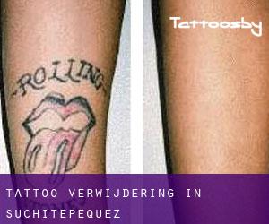 Tattoo verwijdering in Suchitepéquez