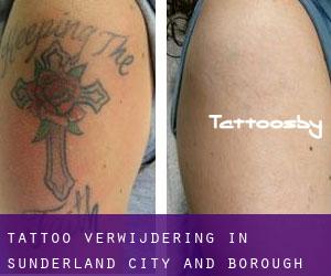 Tattoo verwijdering in Sunderland (City and Borough)