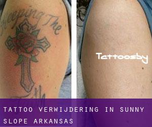 Tattoo verwijdering in Sunny Slope (Arkansas)
