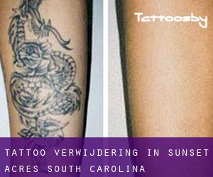 Tattoo verwijdering in Sunset Acres (South Carolina)