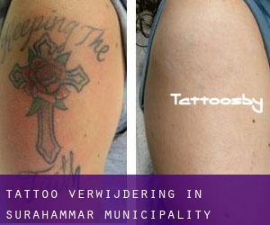 Tattoo verwijdering in Surahammar Municipality