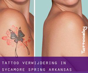 Tattoo verwijdering in Sycamore Spring (Arkansas)