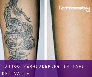 Tattoo verwijdering in Tafí del Valle