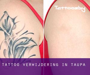 Tattoo verwijdering in Taupa