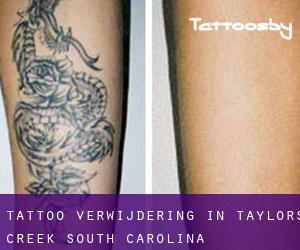 Tattoo verwijdering in Taylors Creek (South Carolina)