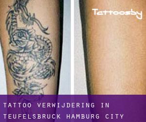 Tattoo verwijdering in Teufelsbrück (Hamburg City)