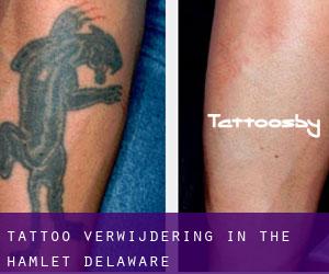 Tattoo verwijdering in The Hamlet (Delaware)