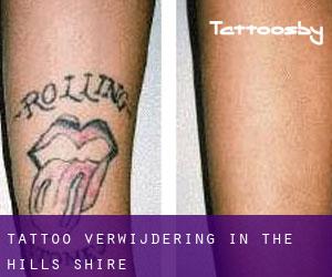 Tattoo verwijdering in The Hills Shire