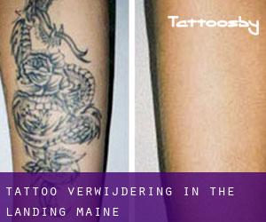 Tattoo verwijdering in The Landing (Maine)