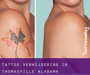 Tattoo verwijdering in Thomasville (Alabama)