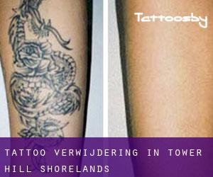 Tattoo verwijdering in Tower Hill Shorelands