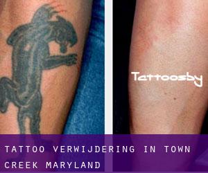 Tattoo verwijdering in Town Creek (Maryland)