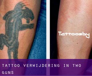Tattoo verwijdering in Two Guns