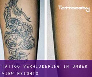 Tattoo verwijdering in Umber View Heights