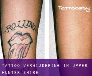 Tattoo verwijdering in Upper Hunter Shire