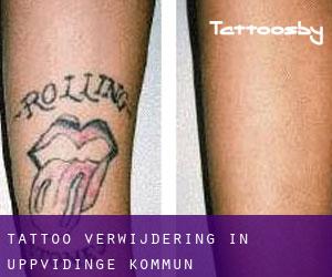 Tattoo verwijdering in Uppvidinge Kommun