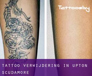 Tattoo verwijdering in Upton Scudamore