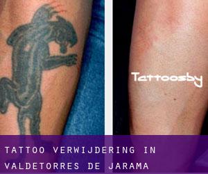 Tattoo verwijdering in Valdetorres de Jarama