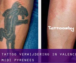 Tattoo verwijdering in Valence (Midi-Pyrénées)