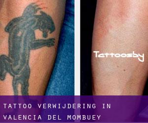 Tattoo verwijdering in Valencia del Mombuey
