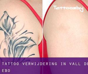 Tattoo verwijdering in Vall de Ebo