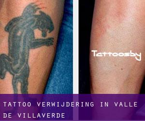 Tattoo verwijdering in Valle de Villaverde