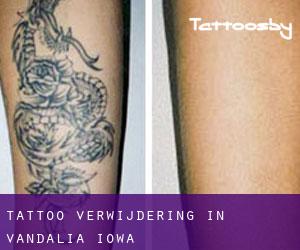 Tattoo verwijdering in Vandalia (Iowa)