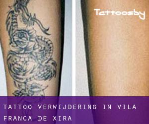 Tattoo verwijdering in Vila Franca de Xira