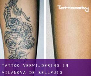 Tattoo verwijdering in Vilanova de Bellpuig
