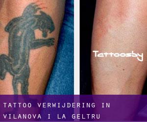 Tattoo verwijdering in Vilanova i la Geltrú