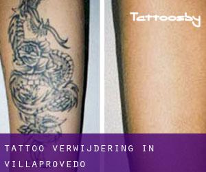 Tattoo verwijdering in Villaprovedo