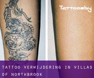 Tattoo verwijdering in Villas of Northbrook