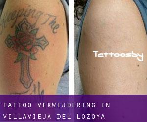 Tattoo verwijdering in Villavieja del Lozoya
