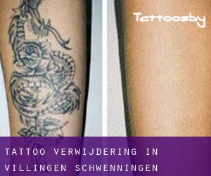 Tattoo verwijdering in Villingen-Schwenningen