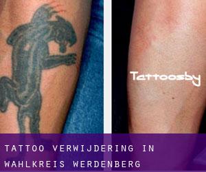 Tattoo verwijdering in Wahlkreis Werdenberg