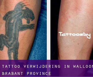 Tattoo verwijdering in Walloon Brabant Province
