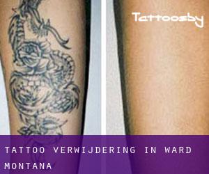 Tattoo verwijdering in Ward (Montana)