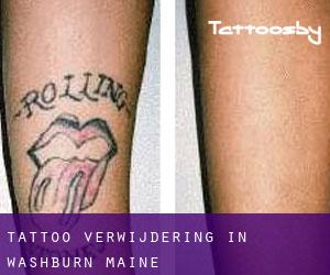 Tattoo verwijdering in Washburn (Maine)